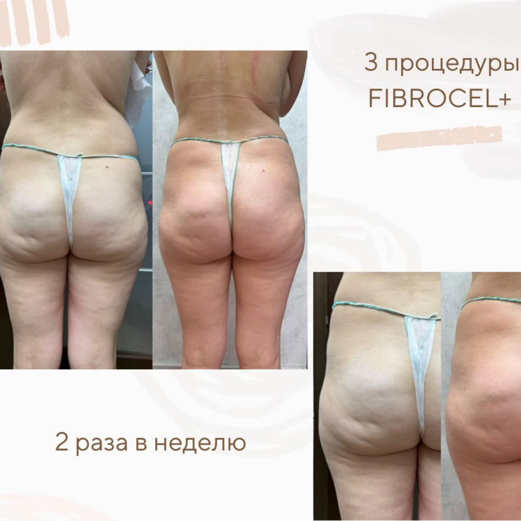 Бандажное обертывание Arosha (пакет) 8 процедур