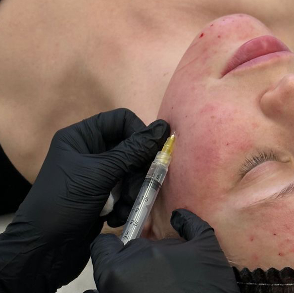 Ботулинотерапия