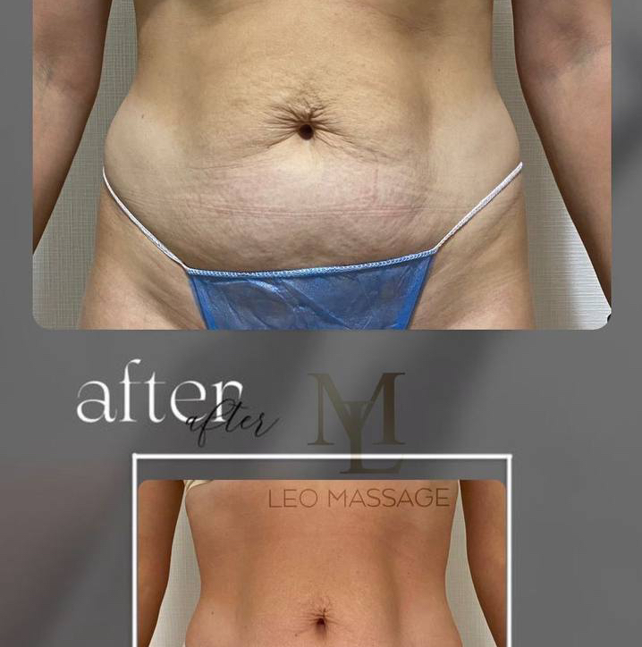 Прессотерапия