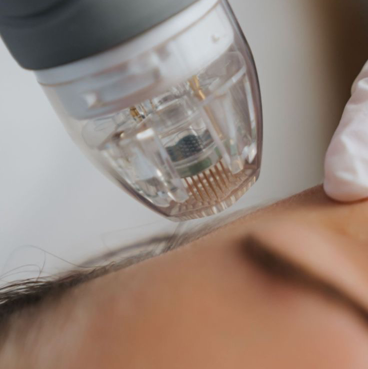 Микроигольчатый RF лифтинг