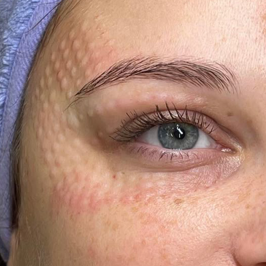 Мезотерапия вокруг глаз