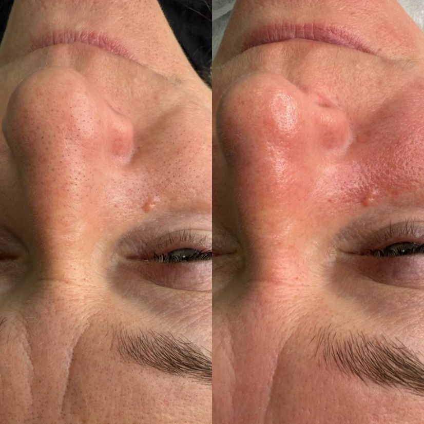 Ультразвуковая чистка лица