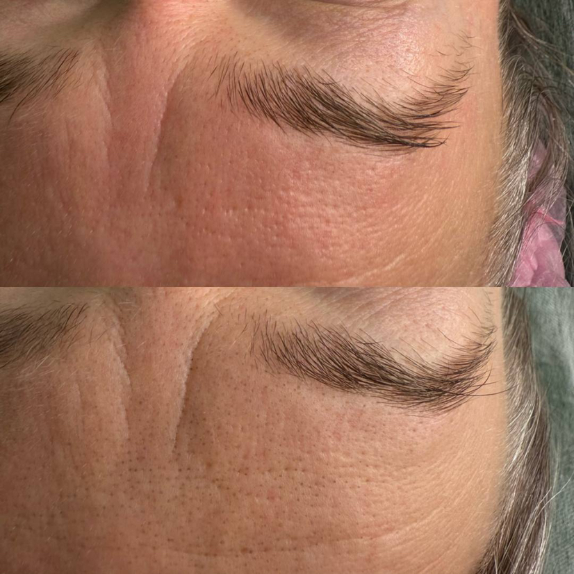 Комбинированная чистка лица