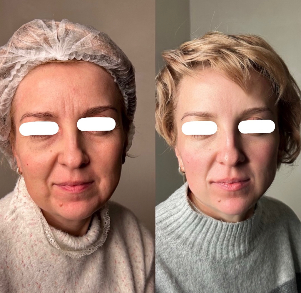 Динамический (круговой) Смас лифтинг V-Max