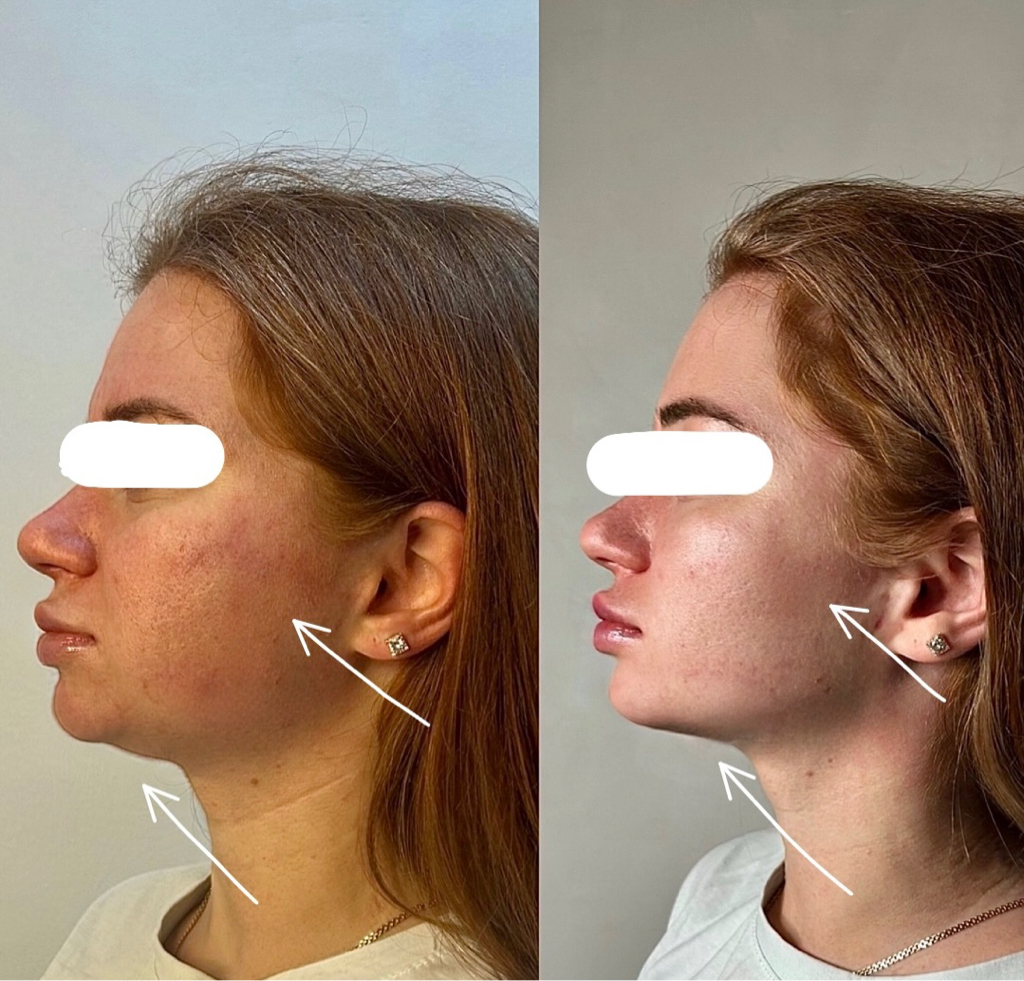 Смас лифтинг нижняя треть лица 300 линий