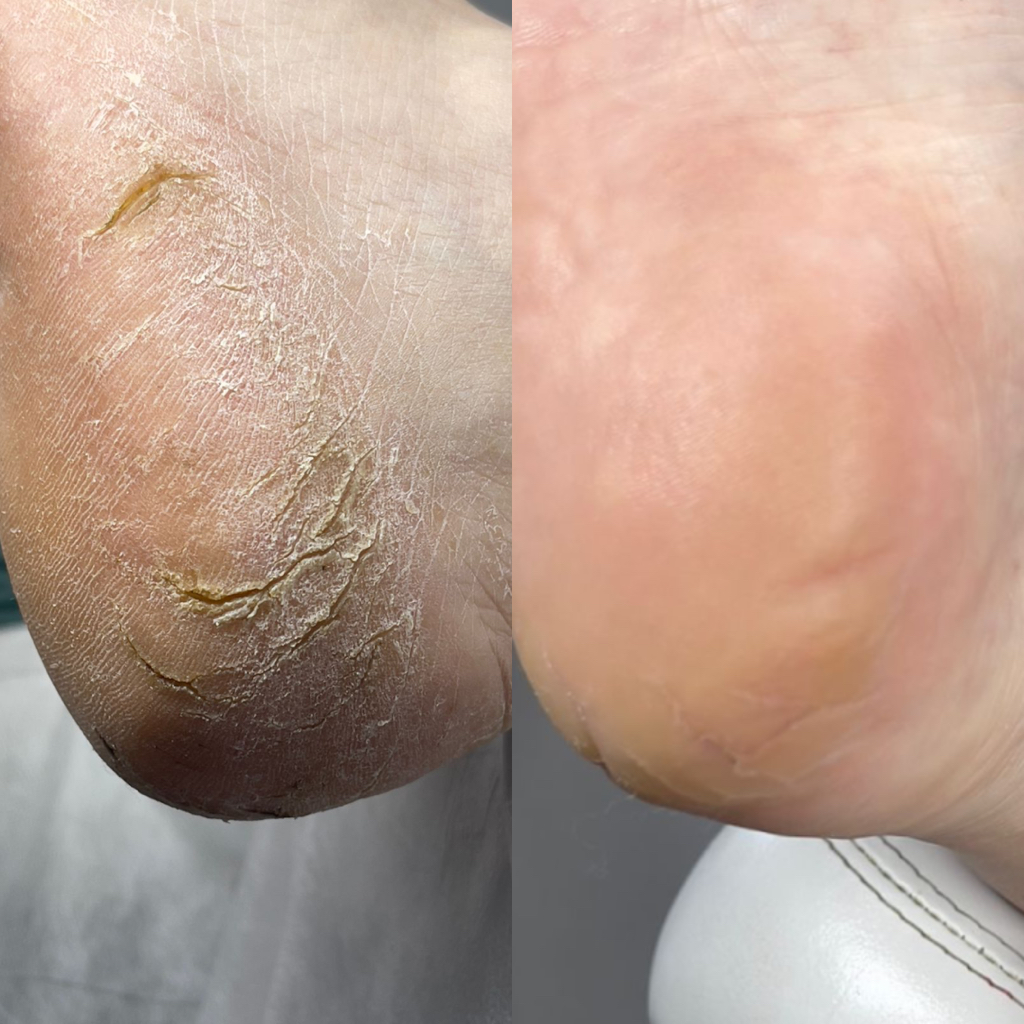 Полный педикюр (сложная обработка)