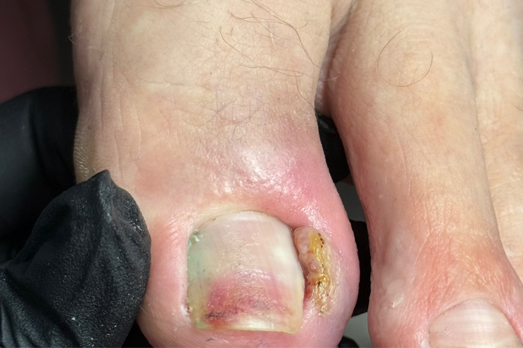 Удаление вросшего ногтя