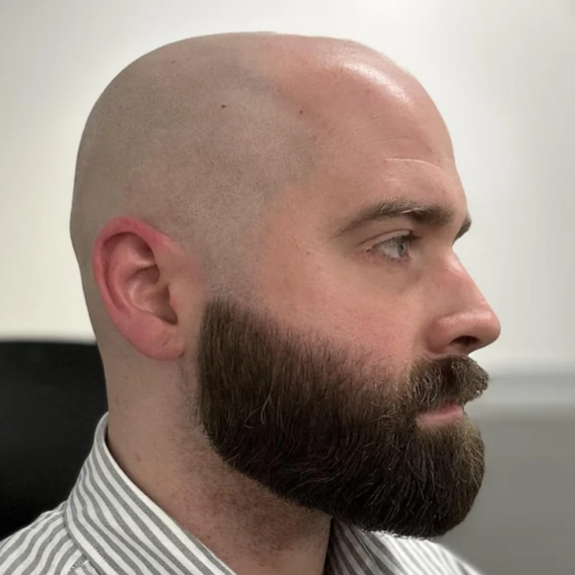 Эпиляция головы