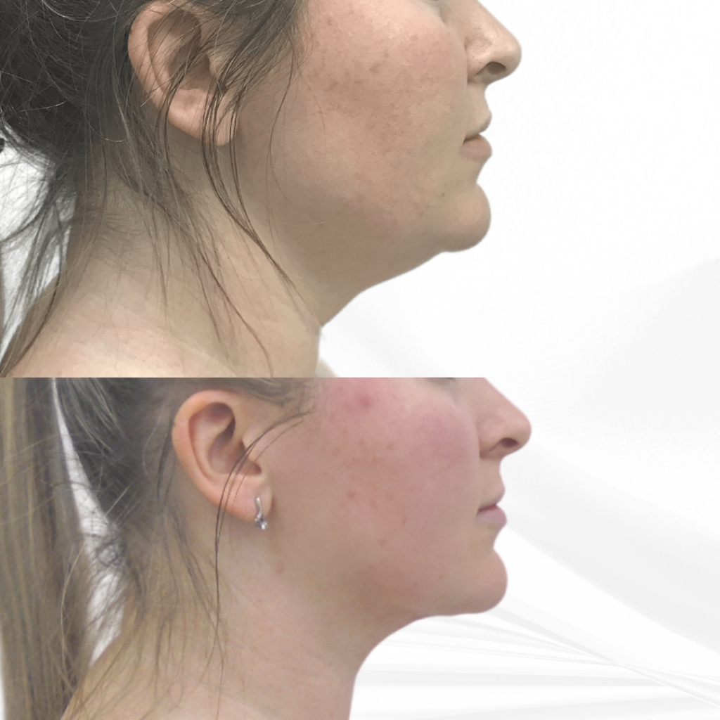 Липолитики от второго подбородка