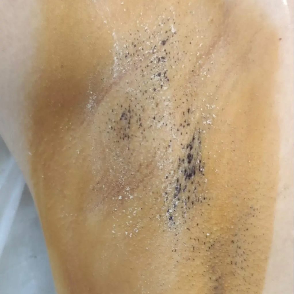 Лечение гипергидроза (повышенное потоотделение)