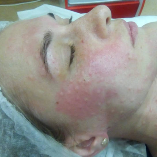 Мезотерапия и биоревитализация