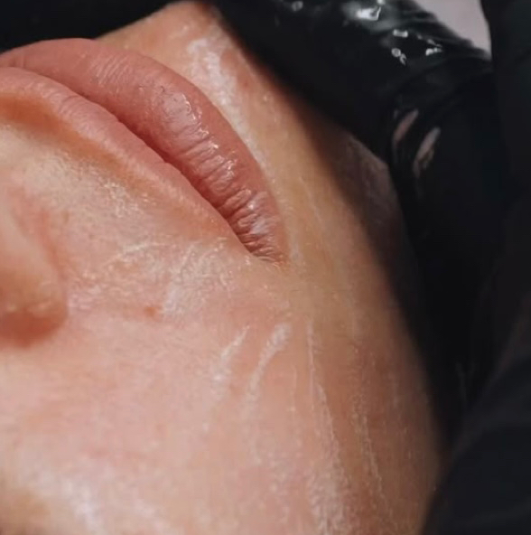 Химический пилинг