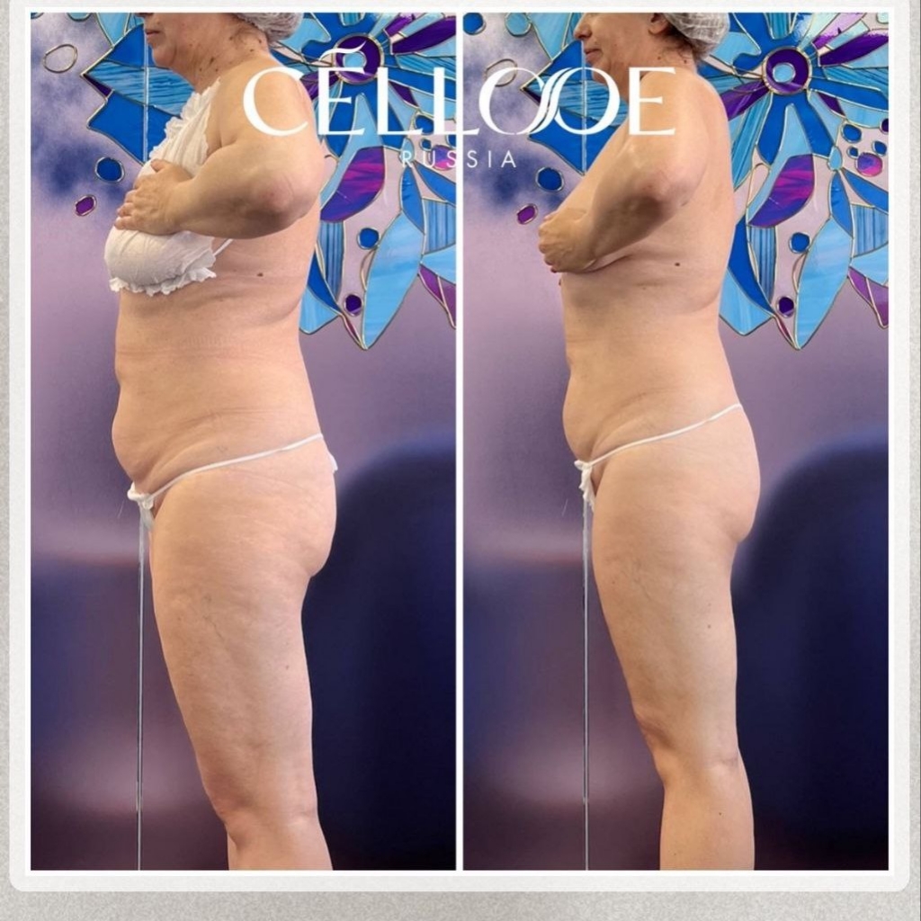 коррекция живота/бёдер и ягодиц с обёртыванием cellooe 40 мин
