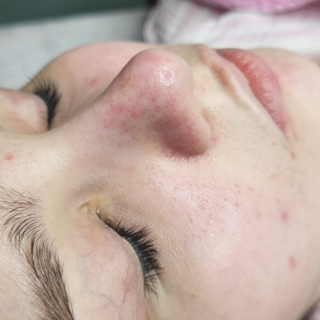 Комбинированная чистка лица