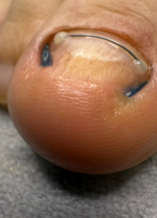 Подологический педикюр