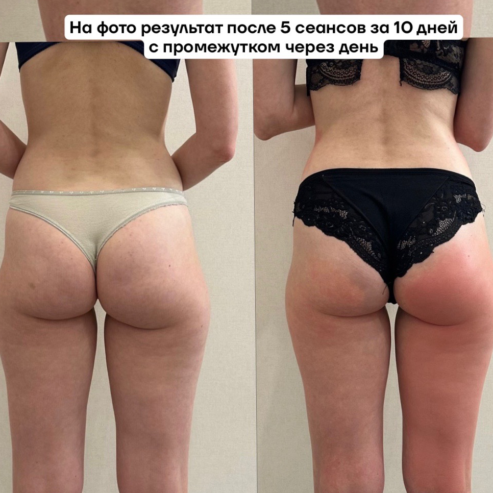 Антицеллюлитный массаж (бедра + ягодицы)