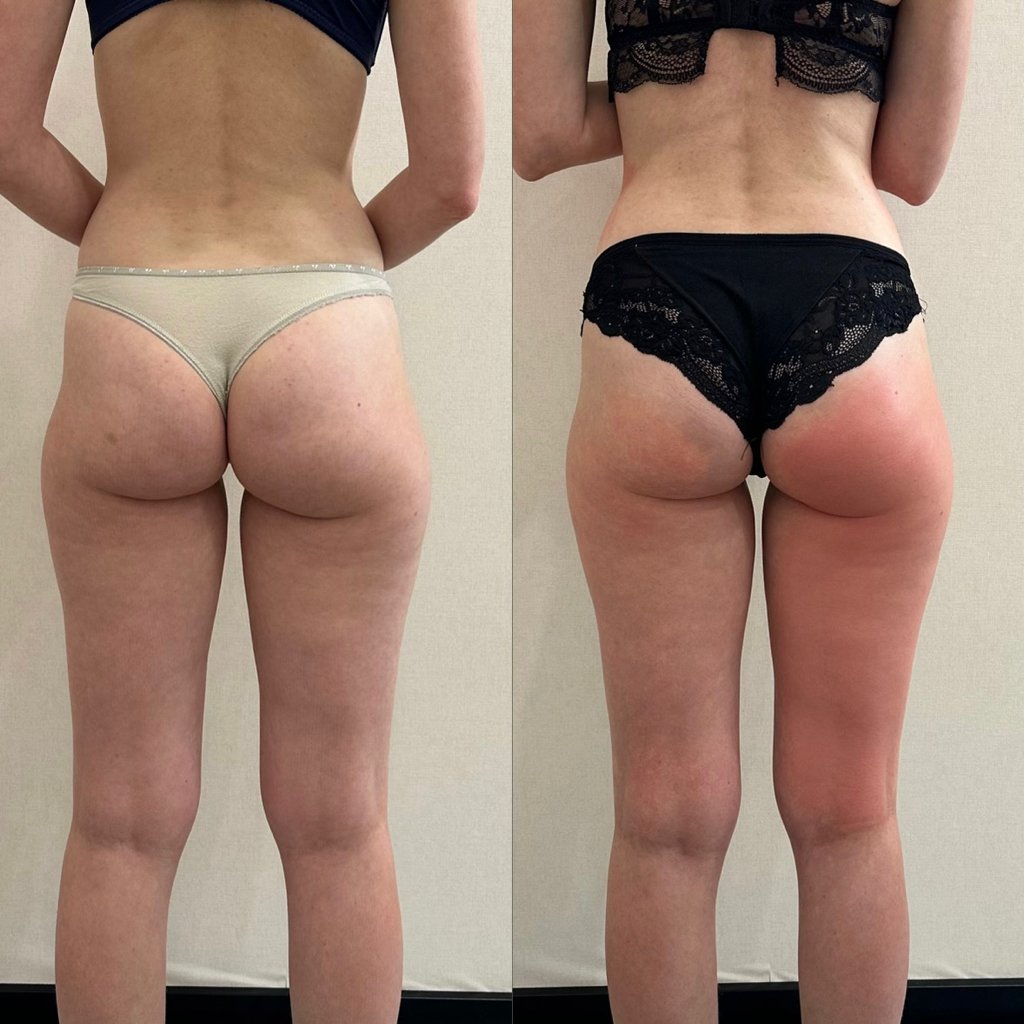 Антицеллюлитный массаж (Живот, бока, бедра, ягодицы)