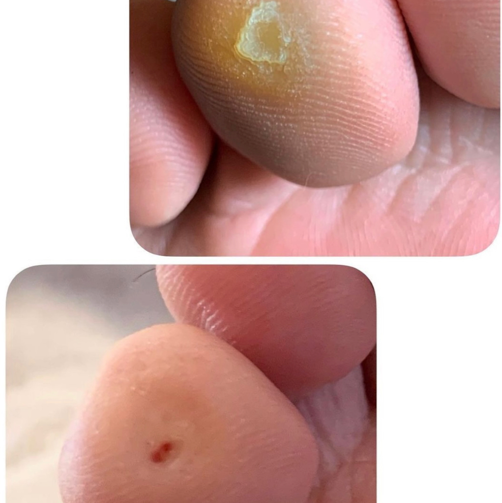 Обработка стержневой мозоли