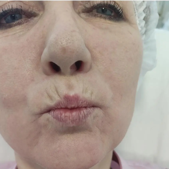 Контурная пластика зоны вокруг рта