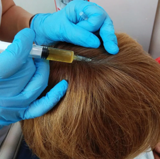 Мезотерапия кожи головы