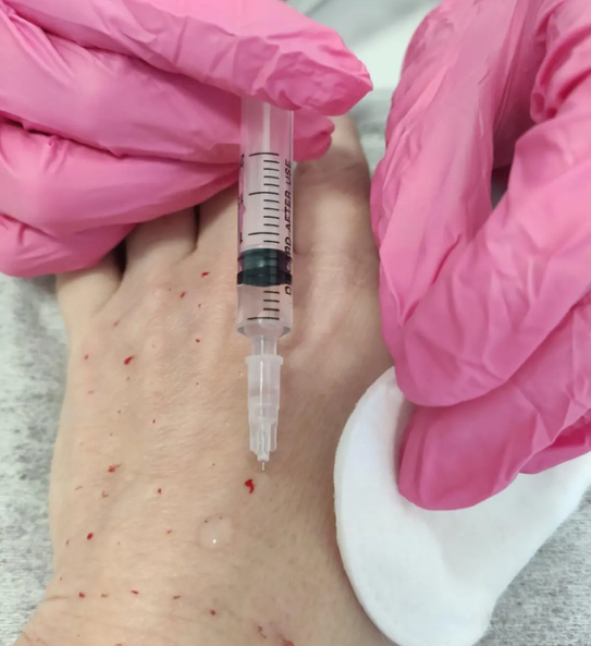 Биоревитализация кожи рук