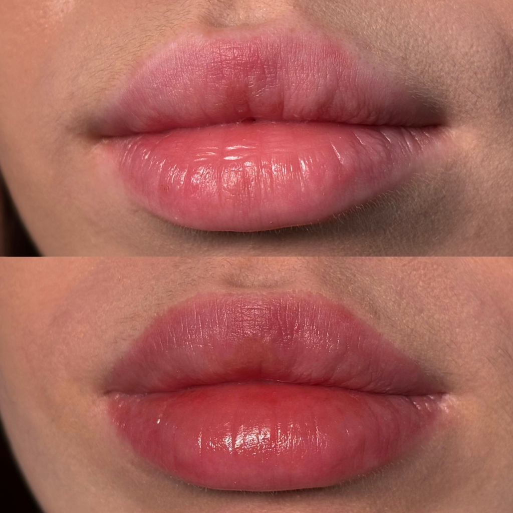 Коррекция ПМ губ (не позже 3-х месяцев)