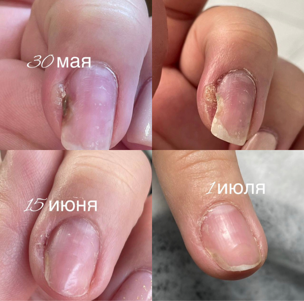Восстановление ногтей (онихолизис,травма)