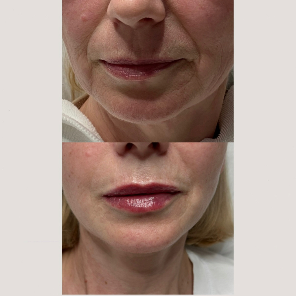 Заполнение носогубных складок