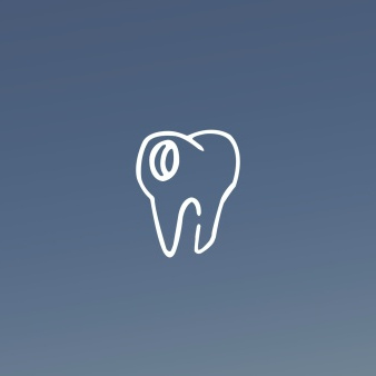 Лечение глубокого кариеса