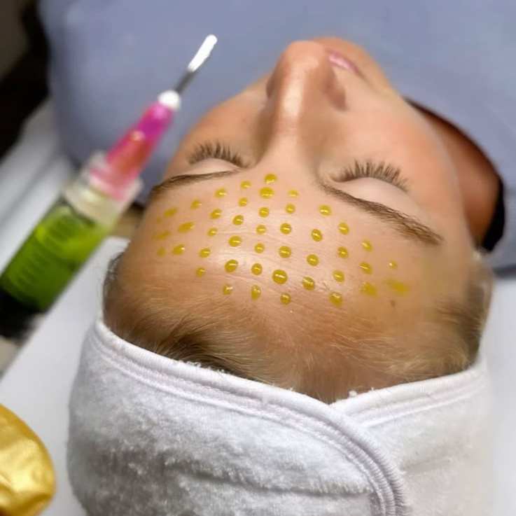 Biorepeel пилинг терапия