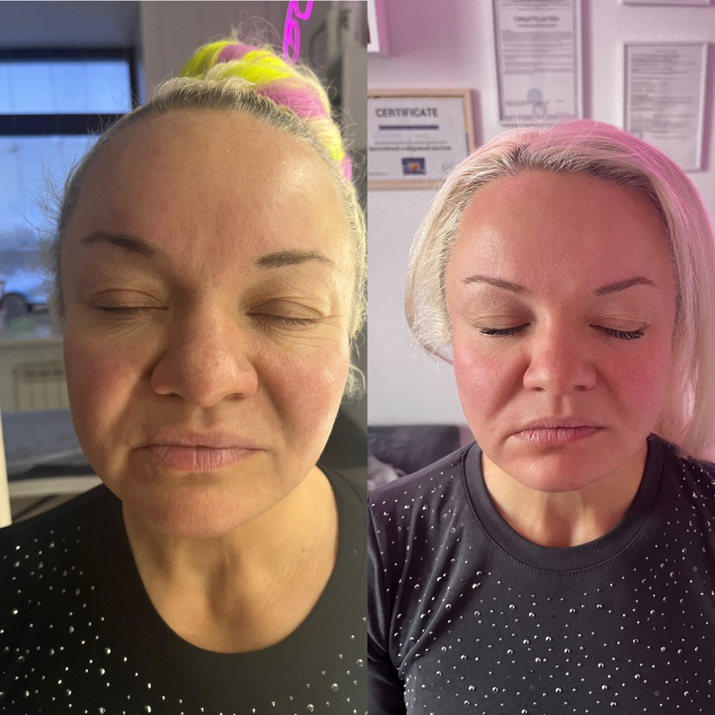 Миофасциальный ,пластический,буккальный массаж лица