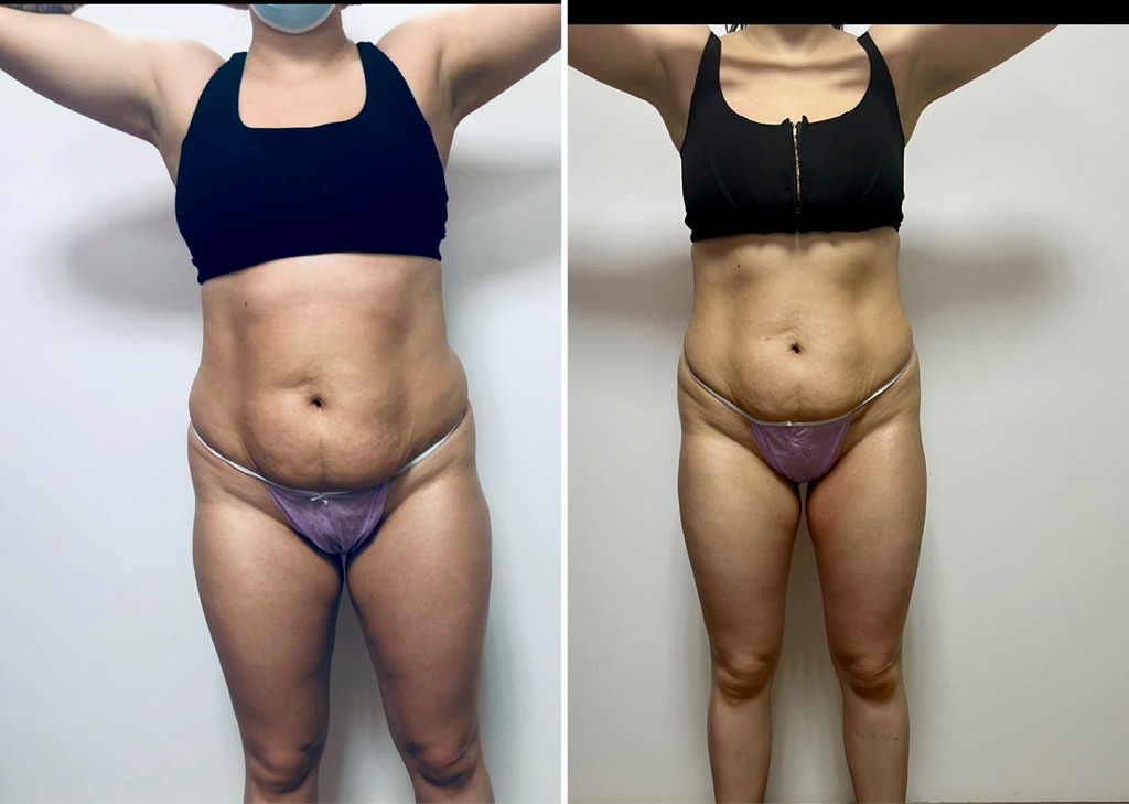 Антицеллюлитный массаж