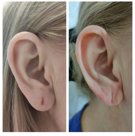 Контурная пластика мочки уха