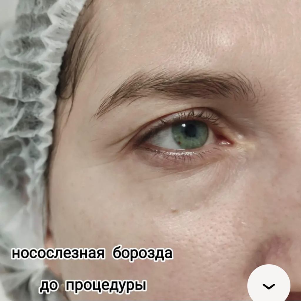 Контурная пластика носослезной борозды