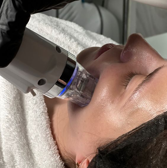 Микроигольчатый RF лифтинг (Лицо + шея)