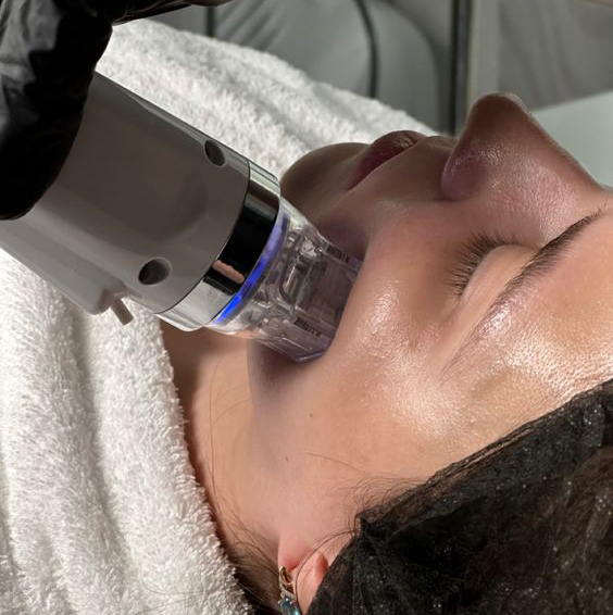 Микроигольчатый RF лифтинг (Лицо + шея + декольте)