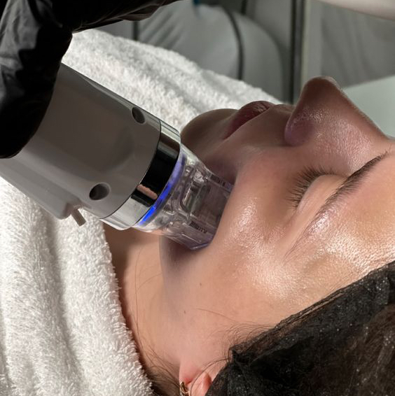 Микроигольчатый RF лифтинг (Лицо полностью)