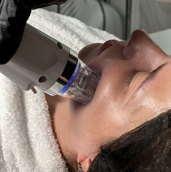 Микроигольчатый RF лифтинг (Шея + декольте)