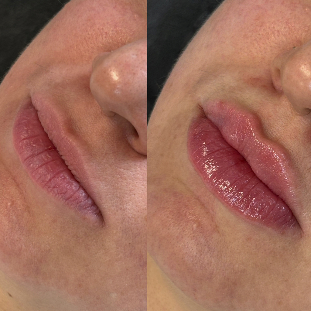 Биоревитализация губ и периоральной области