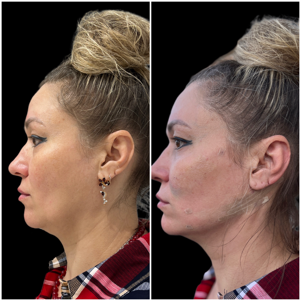 Петля Груздева