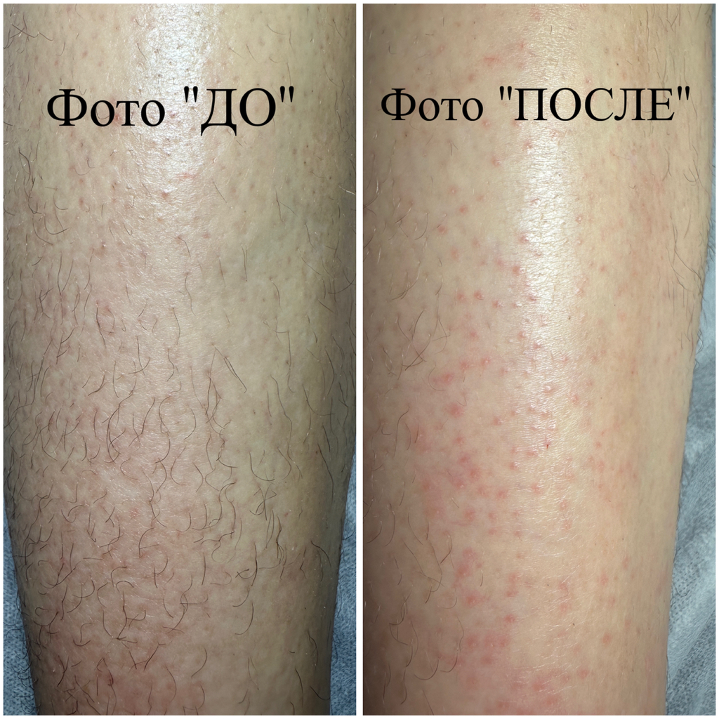 Электроэпиляция голени
