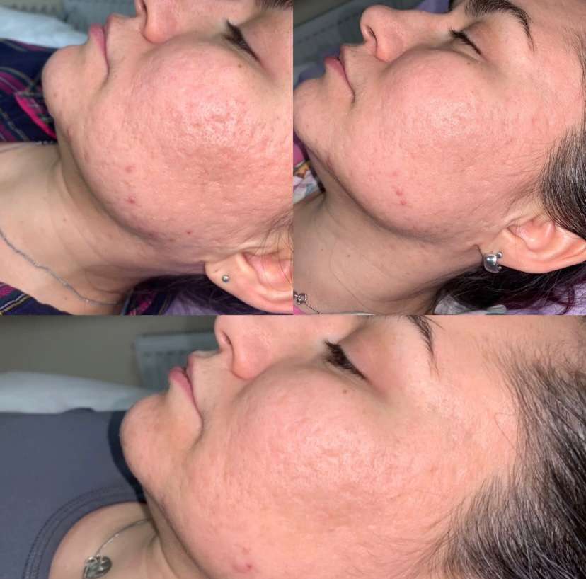 Жёлтый пилинг