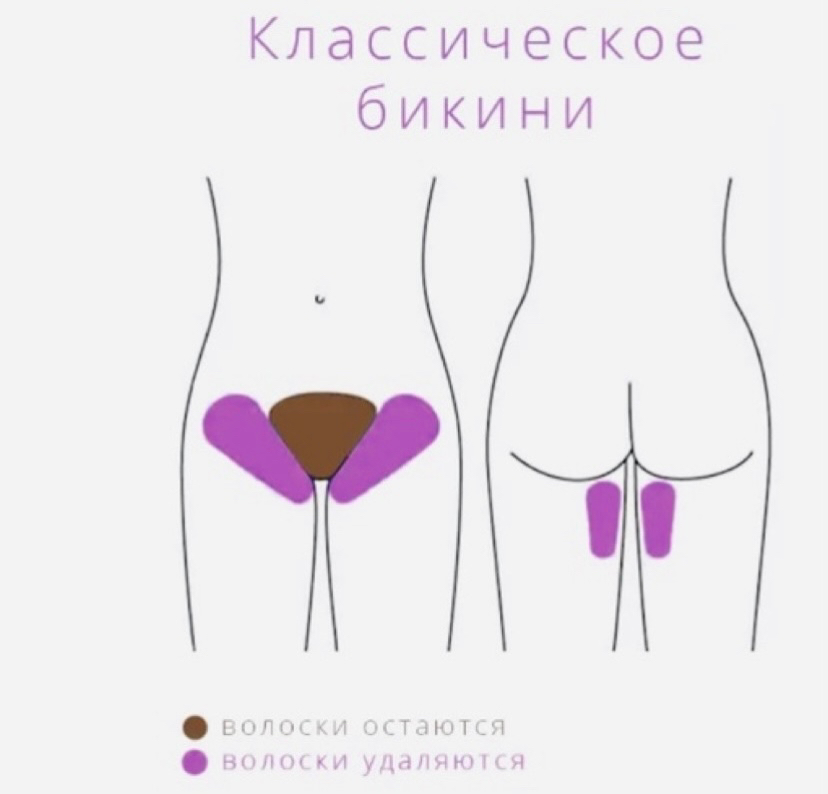 Депиляция Бикини классика