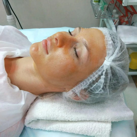 Ретиноловый - желтый пилинг