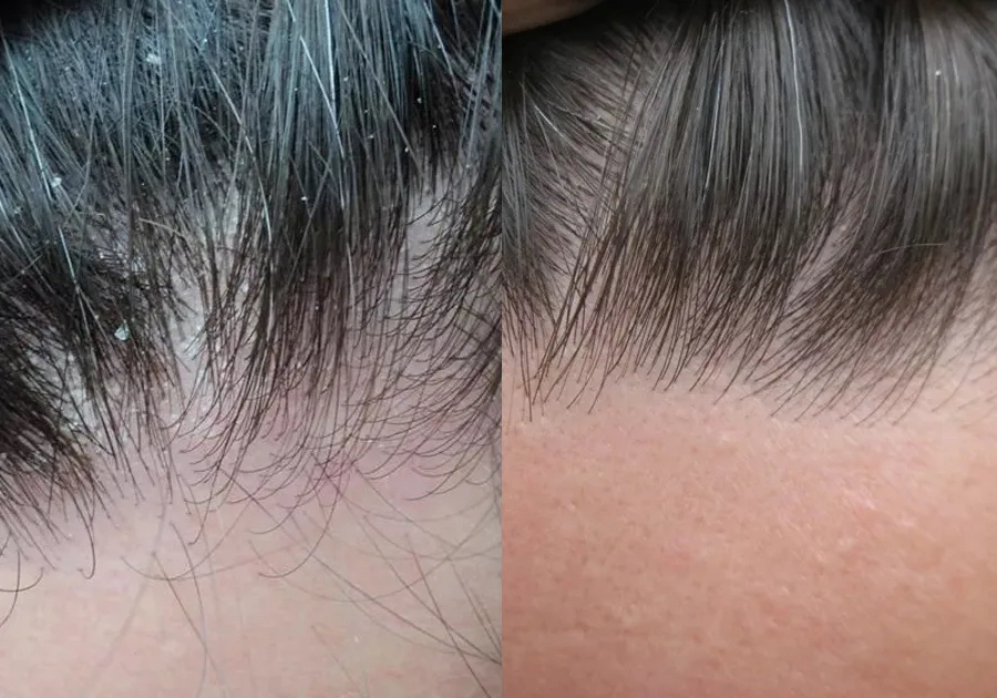 Пилинг кожи головы