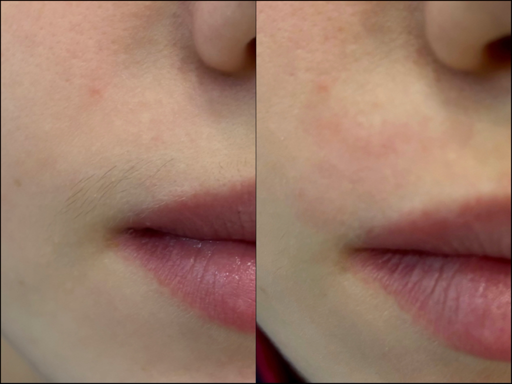 Депиляция усов