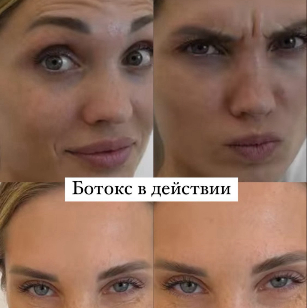 Ботокс лоб и межбровка