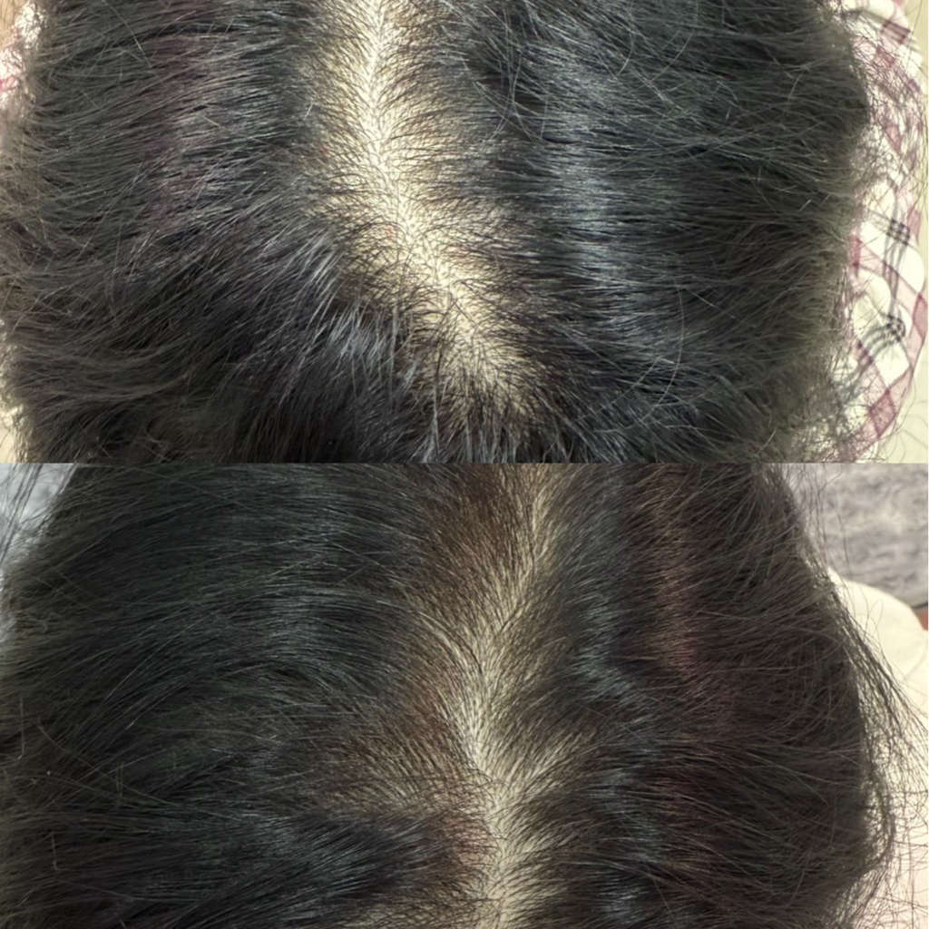 Плазмотерапия