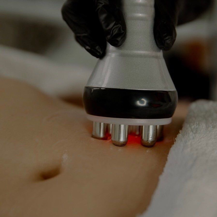 RF-лифтинг  тела