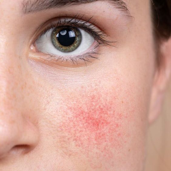 Программа антикупероз